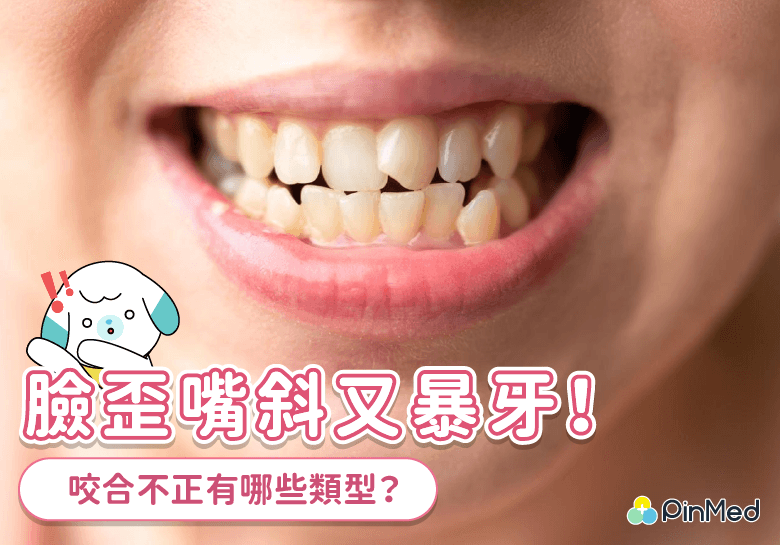 咬合不正